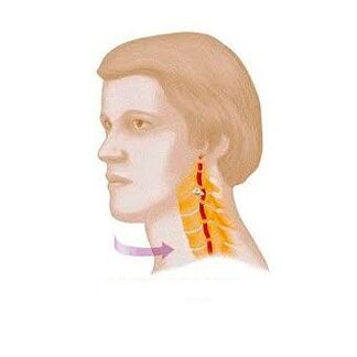 vertebral syndrome na may servikal osteochondrosis