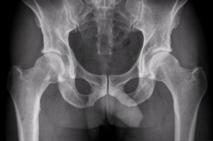 x-ray ng hip joint para sa pananakit