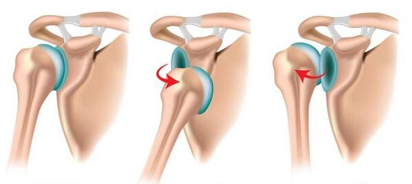 Ang anterior at posterior dislocation ng joint ng balikat, na pumukaw sa pag-unlad ng arthrosis