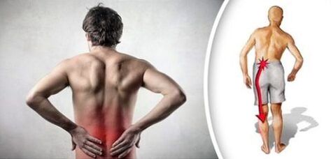 Ang sakit sa sindrom na may lumbar osteochondrosis ay sumasalamin sa mga binti