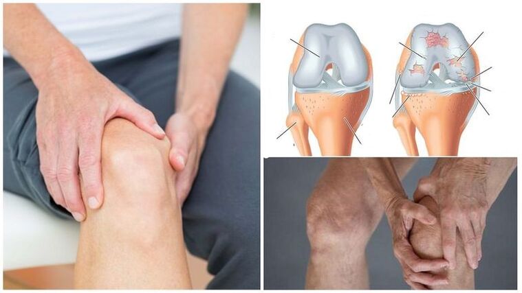 Ang sintomas ng sakit sa tuhod ng arthrosis ng kasukasuan ng tuhod