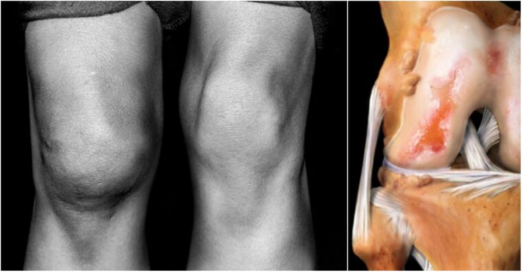 Arthrosis ng kasukasuan ng tuhod at namamagang pinagsamang