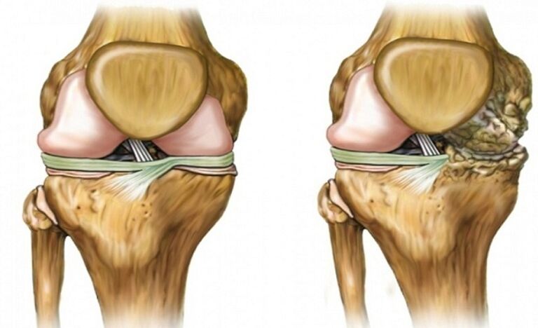 Malusog at apektado ng pinagsamang arthrosis