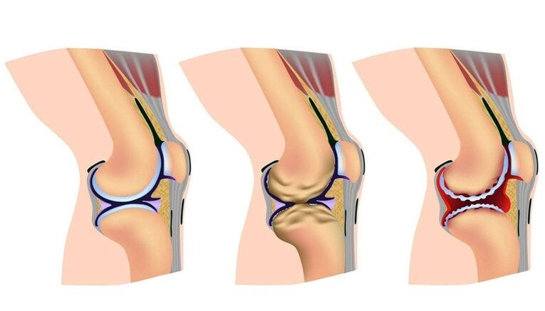Mga yugto ng pagpapapangit sa kasukasuan ng tuhod para sa arthrosis