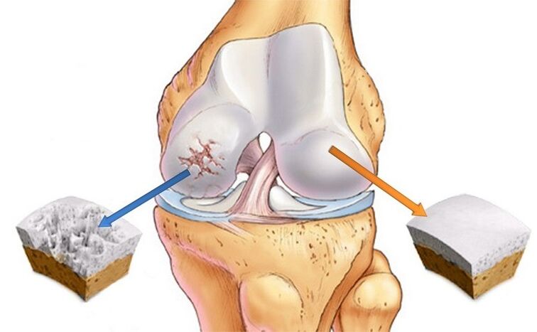 normal na kartilago at apektado ng arthrosis