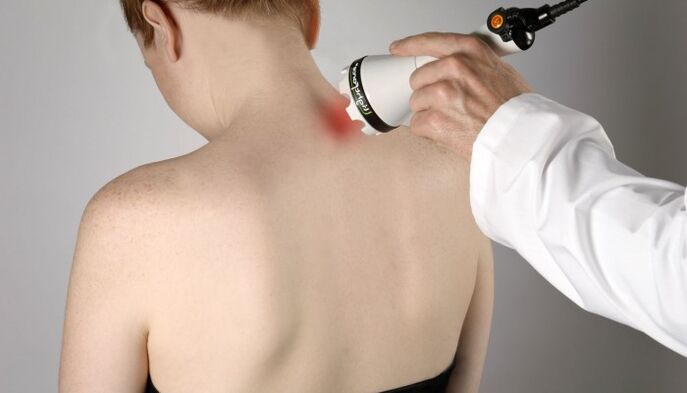 Laser therapy para sa cervical osteochondrosis