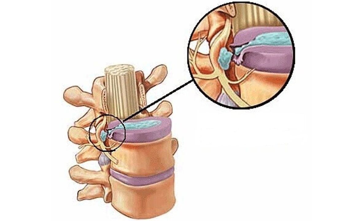 intervertebral hernia na may thoracic osteochondrosis