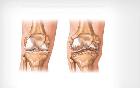 arthrosis ng kasukasuan ng tuhod