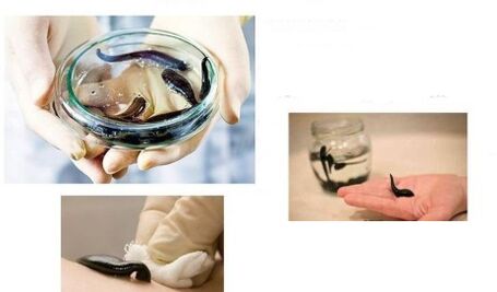 hirudotherapy para sa arthrosis