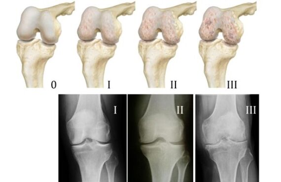 mga pamamaraan para sa pag-diagnose ng arthrosis ng tuhod