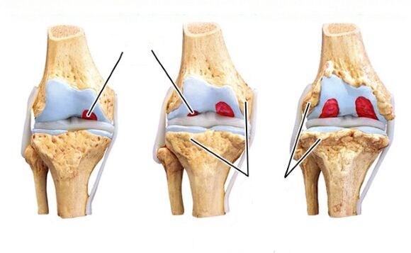 mga yugto ng arthrosis ng tuhod